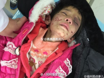 5周歲的小肖身上有許多傷痕