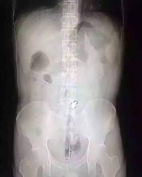 男子肛門被塞20公分長異物 稱年會(huì)被惡搞 男子肛門被塞20公分長異物 稱年會(huì)被惡搞